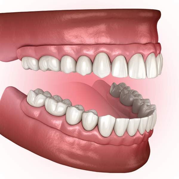dentures