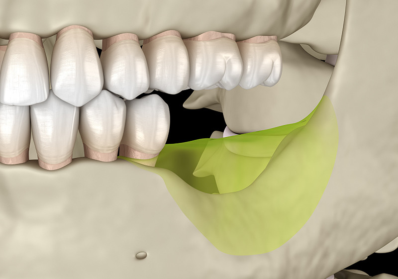 Mandibular,Jaw,,Bone,Recession,After,Losing,Molars,Teeth.,Medically,Accurate