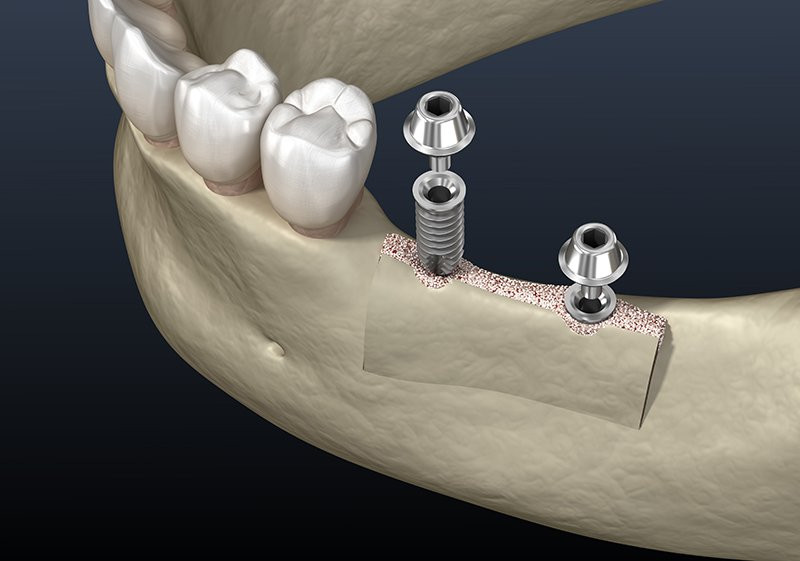 Cleavage,Of,The,Alveolar,Ridge,:,Implantation.,Dental,Surgery,,3d